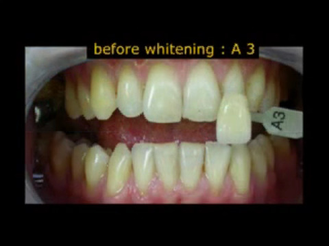 【免費醫療App】Teeth Whitening Techniques-APP點子