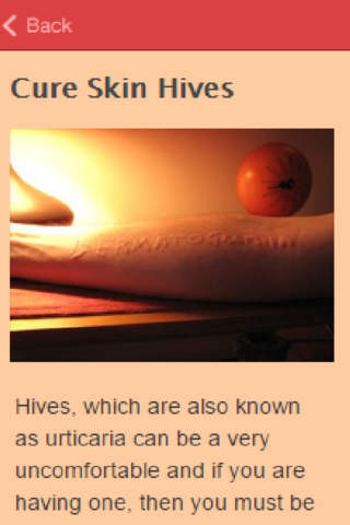 How To Get Rid Of Hives screenshot 2
