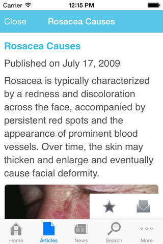 Rosacea by AZoMedical - náhled
